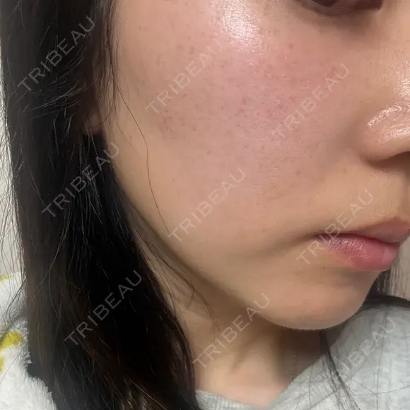 イオン導入 / 毛穴洗浄（ハイドラフェイシャルなど） / ルメッカ ルラ美容クリニック 岡山院 DAY 21 メイン用