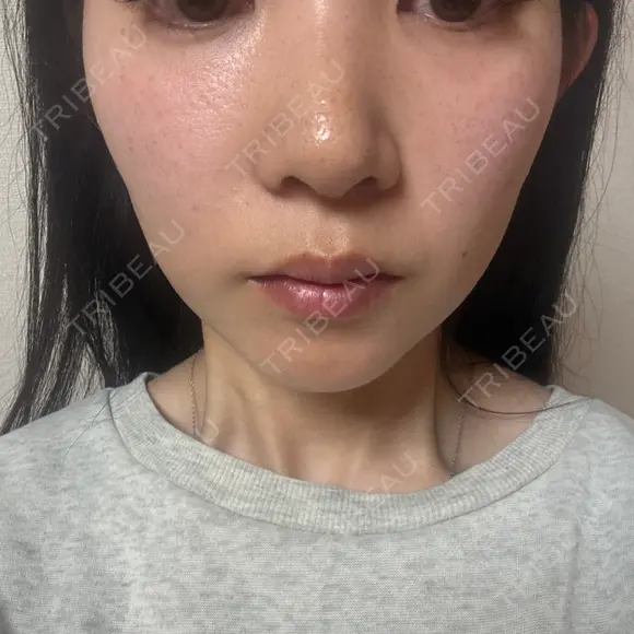イオン導入 / 毛穴洗浄（ハイドラフェイシャルなど） / ルメッカ ルラ美容クリニック 岡山院 DAY 21 メイン用
