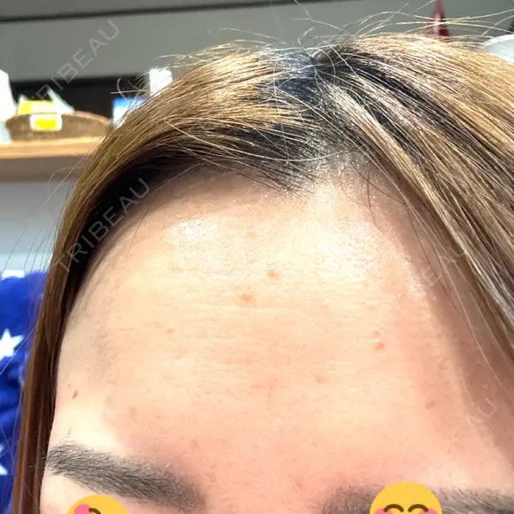 ボトックス（額） ルラ美容クリニック 郡山院 AFTER メイン用