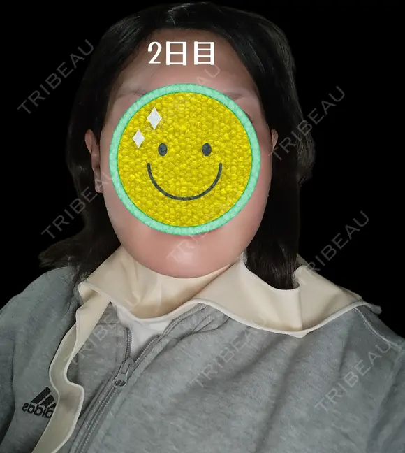 糸リフト / 脂肪吸引（顔） Days Beauty Clinic 新宿院 DAY 2 メイン用