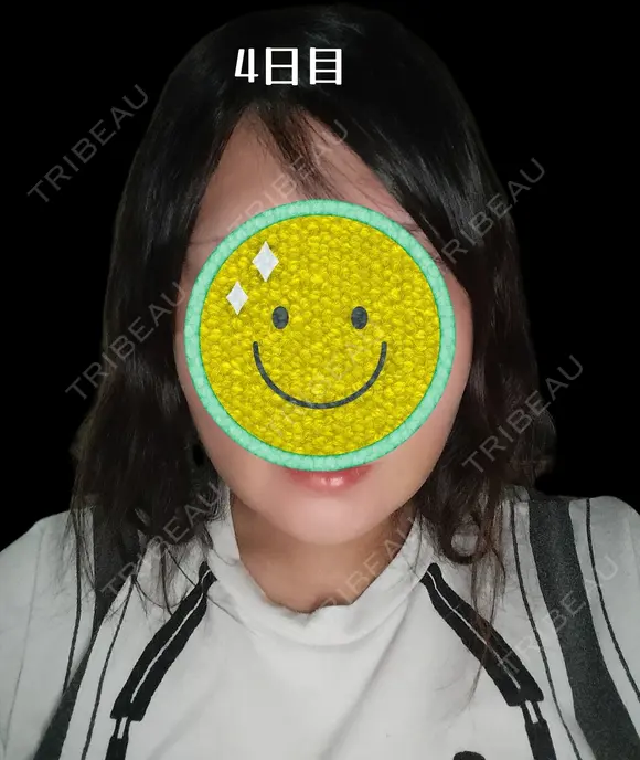 糸リフト / 脂肪吸引（顔） Days Beauty Clinic 新宿院 AFTER メイン用