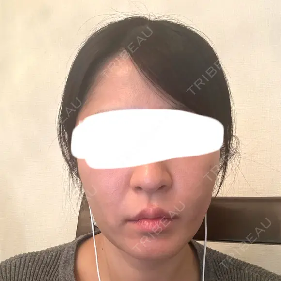 脂肪吸引注射（顔） 新宿美容外科ネビュラクリニック DAY 18 メイン用