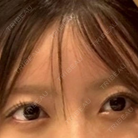 ヒアルロン酸注入（涙袋） eクリニック 横浜みなとみらい院 AFTER メイン用