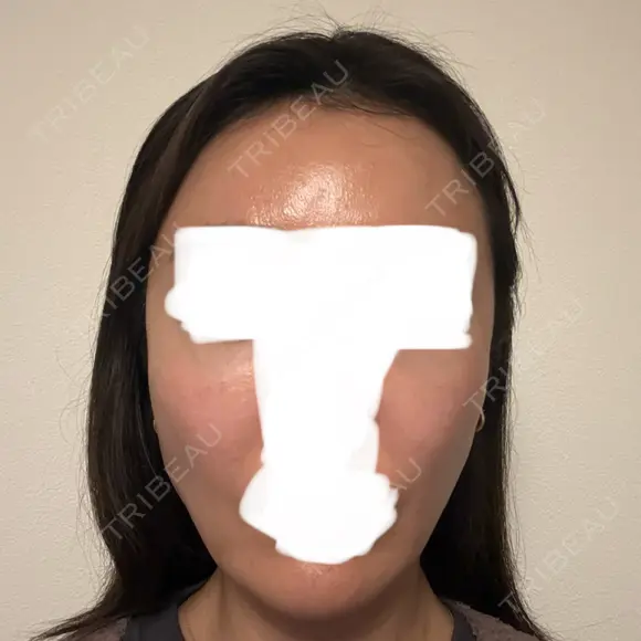 ボトックス（エラ・小顔） / ヒアルロン酸注入（額） / ヒアルロン酸注入（頬） / デンシティ フィラークリニック 新宿院 AFTER メイン用