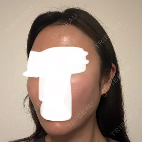 ボトックス（エラ・小顔） / ヒアルロン酸注入（額） / ヒアルロン酸注入（頬） / デンシティ フィラークリニック 新宿院 DAY 5 メイン用