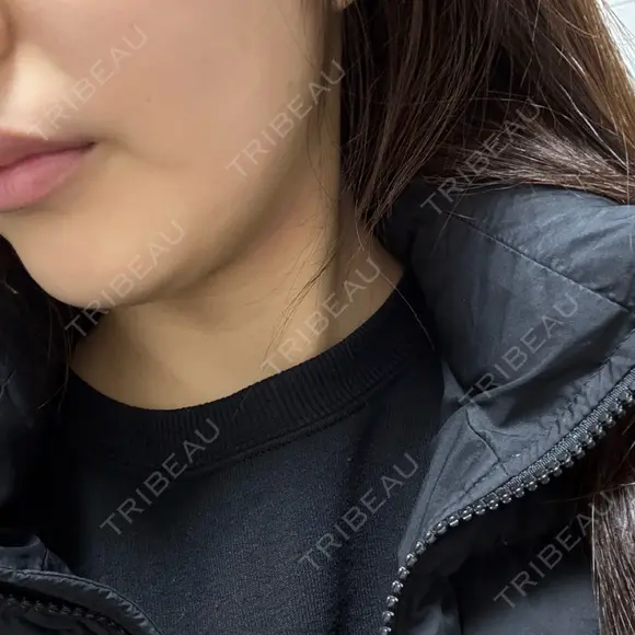 インモード Moon Beauty Clinic DAY 1 メイン用