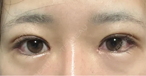 二重埋没 / 目頭切開 / 目尻切開 / タレ目形成・グラマラスライン（切開） ziz CLINIC DAY 8 メイン用