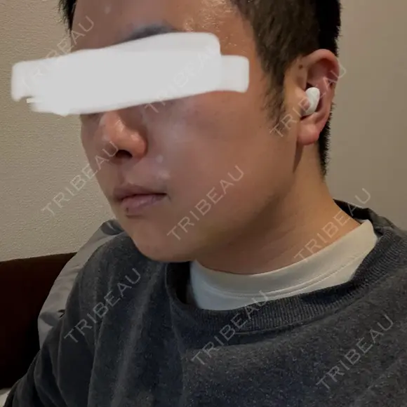 脂肪溶解注射（顔） 上野注入クリニック DAY 8 メイン用