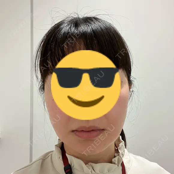 糸リフト / 肌育注射（ジュベルックなど） 東京ココセランクリニック DAY 21 メイン用