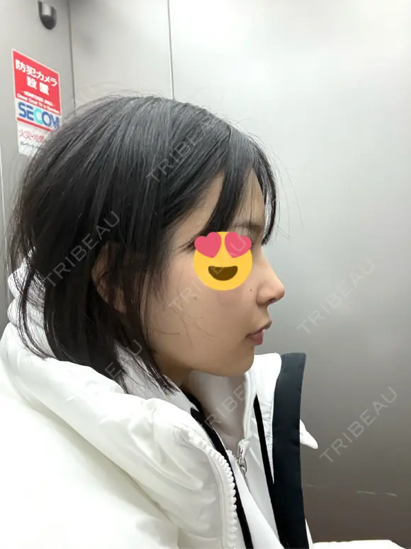 隆鼻術 / 鼻尖形成（切開） / 鼻中隔延長（切開） / 小鼻縮小（切開） / 軟骨移植 / 鼻修正 / 鼻孔縁下降 シンデレラ＆ダヴィンチクリニック DAY 7 メイン用