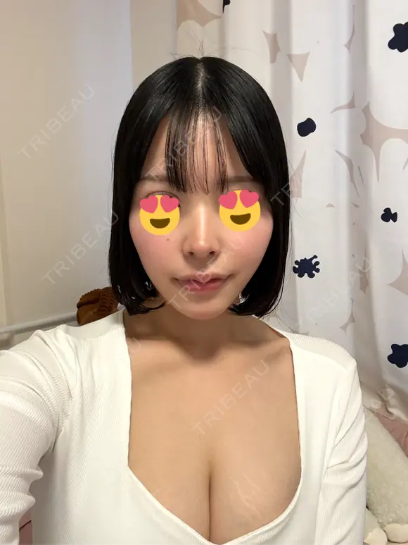隆鼻術 / 鼻尖形成（切開） / 鼻中隔延長（切開） / 小鼻縮小（切開） / 軟骨移植 / 鼻修正 / 鼻孔縁下降 シンデレラ＆ダヴィンチクリニック DAY 31 メイン用