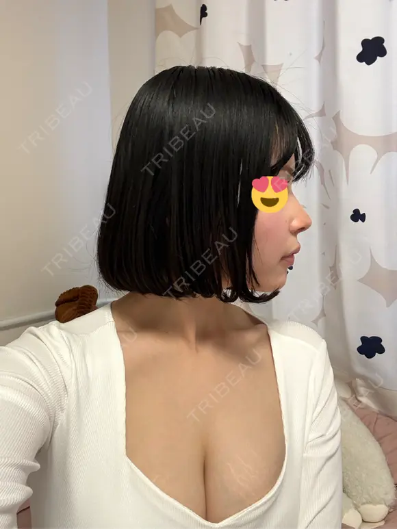 隆鼻術 / 鼻尖形成（切開） / 鼻中隔延長（切開） / 小鼻縮小（切開） / 軟骨移植 / 鼻修正 / 鼻孔縁下降 シンデレラ＆ダヴィンチクリニック DAY 31 メイン用
