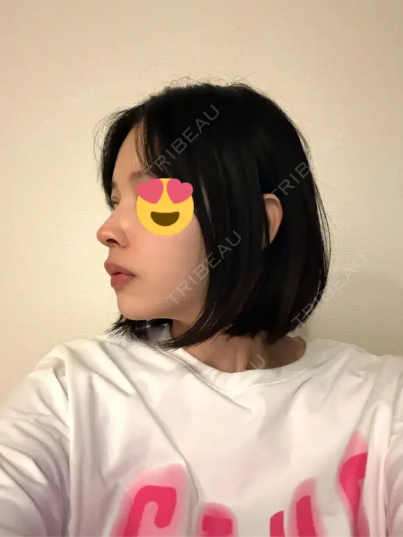 隆鼻術 / 鼻尖形成（切開） / 鼻中隔延長（切開） / 小鼻縮小（切開） / 軟骨移植 / 鼻修正 / 鼻孔縁下降 シンデレラ＆ダヴィンチクリニック DAY 59 メイン用
