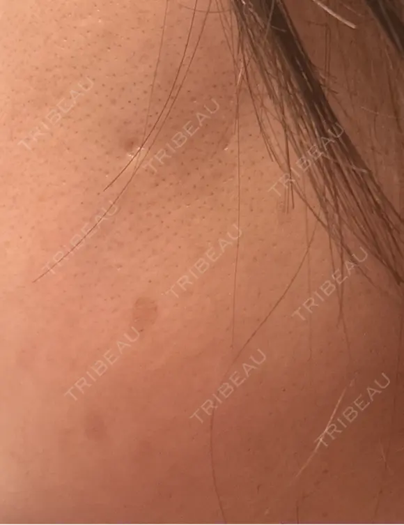 ピーリング（ハリ・ツヤ） / ルメッカ 小倉美容外科/美容皮膚科 ビラビューティークリニック DAY 10 メイン用