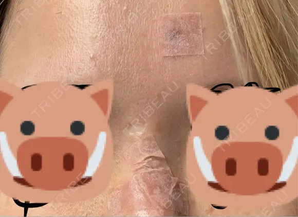 シミ取りレーザー eクリニック 金沢本院 DAY 15 メイン用