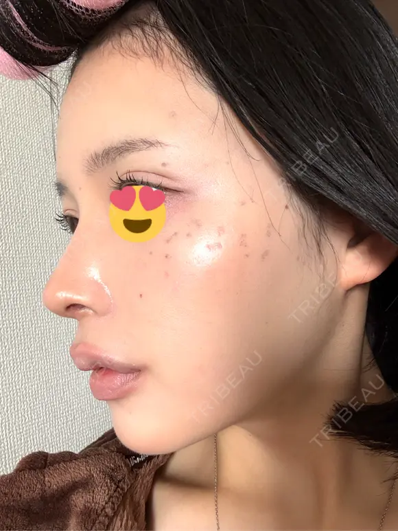 隆鼻術 / 鼻尖形成（切開） / 鼻中隔延長（切開） / 小鼻縮小（切開） / 軟骨移植 / 鼻修正 / 鼻孔縁下降 シンデレラ＆ダヴィンチクリニック DAY 65 メイン用