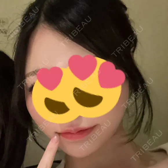 ヒアルロン酸注入（唇） / ヒアルロン酸注入（頬） / ヒアルロン酸注入（鼻翼基部） ルラ美容クリニック 名古屋栄院 / ルラスキンクリニック 名古屋栄院 AFTER メイン用
