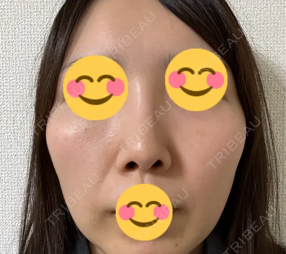 鼻尖形成（切開） / 鼻中隔延長（切開） / 軟骨移植 / 眉間プロテーゼ eクリニック 福岡院 AFTER メイン用