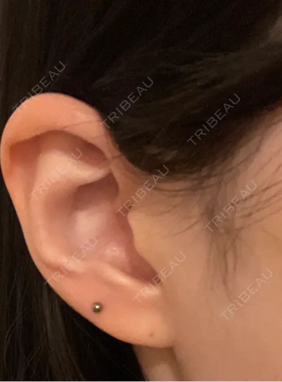 ピアス穴あけ 美容皮膚科エルムクリニック 京都院 AFTER メイン用