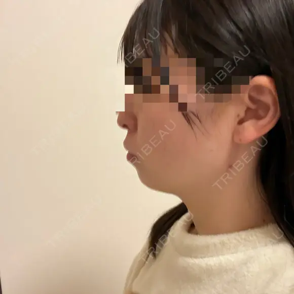 糸リフト / 脂肪吸引（顔） RIVER CLINIC（リバークリニック） DAY 5 メイン用
