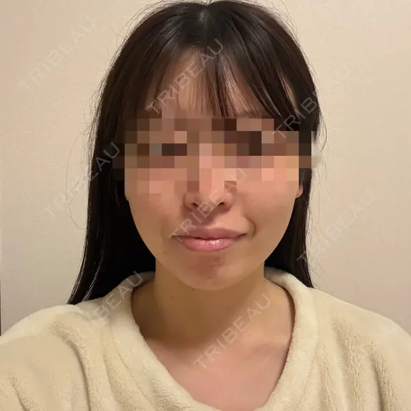 糸リフト / 脂肪吸引（顔） RIVER CLINIC（リバークリニック） DAY 9 メイン用