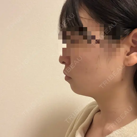 糸リフト / 脂肪吸引（顔） RIVER CLINIC（リバークリニック） DAY 9 メイン用