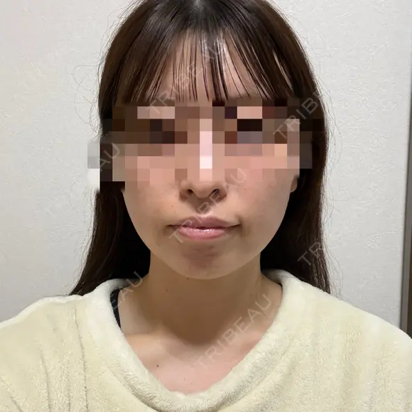 糸リフト / 脂肪吸引（顔） RIVER CLINIC（リバークリニック） DAY 13 メイン用
