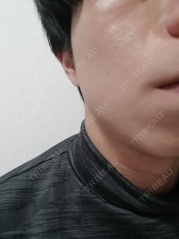 ボトックス（エラ・小顔） 白金ビークリニック 本院 DAY 39 メイン用