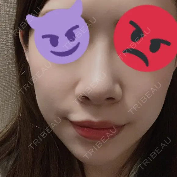 小鼻縮小（切開） / スレッドノーズ / 鼻尖縮小 / ヒアルロン酸注入（鼻） キップン整形外科 DAY 7 メイン用