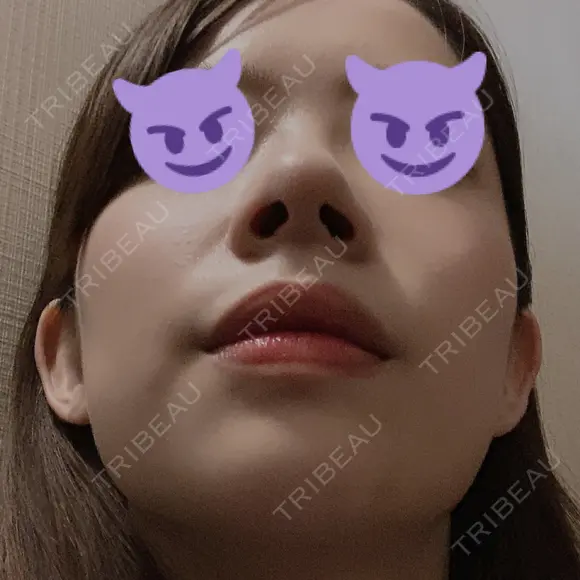 小鼻縮小（切開） / スレッドノーズ / 鼻尖縮小 / ヒアルロン酸注入（鼻） キップン整形外科 DAY 7 メイン用