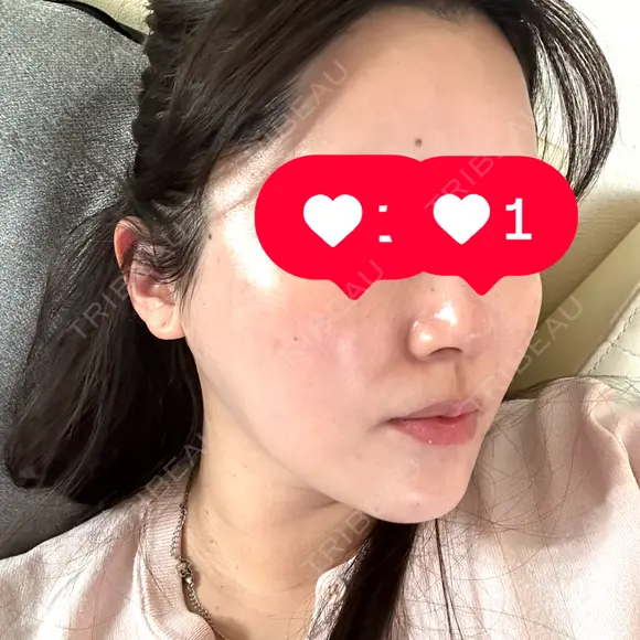 毛穴洗浄（ハイドラフェイシャルなど） / ピーリング（ハリ・ツヤ） KARIS beauty clinic AFTER メイン用