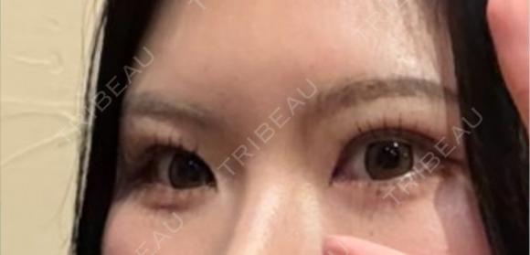 二重埋没 / 糸リフト 銀座みゆき通り美容外科 大阪梅田院 AFTER メイン用