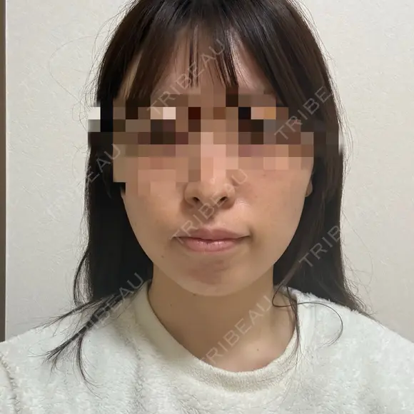 糸リフト / 脂肪吸引（顔） RIVER CLINIC（リバークリニック） AFTER メイン用