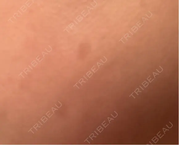 ピーリング（ハリ・ツヤ） / ルメッカ 小倉美容外科/美容皮膚科 ビラビューティークリニック DAY 13 メイン用
