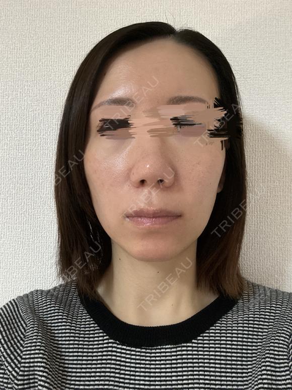 その他（鼻） / 軟骨移植 / ワシ鼻修正・ハンプ切除 / 真皮移植 LUHO（ルホ）美容外科 AFTER メイン用