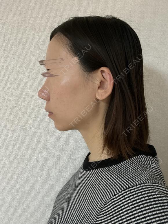 その他（鼻） / 軟骨移植 / ワシ鼻修正・ハンプ切除 / 真皮移植 LUHO（ルホ）美容外科 DAY 182 メイン用