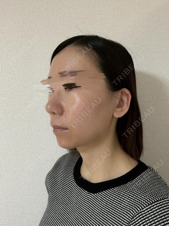 その他（鼻） / 軟骨移植 / ワシ鼻修正・ハンプ切除 / 真皮移植 LUHO（ルホ）美容外科 DAY 182 メイン用