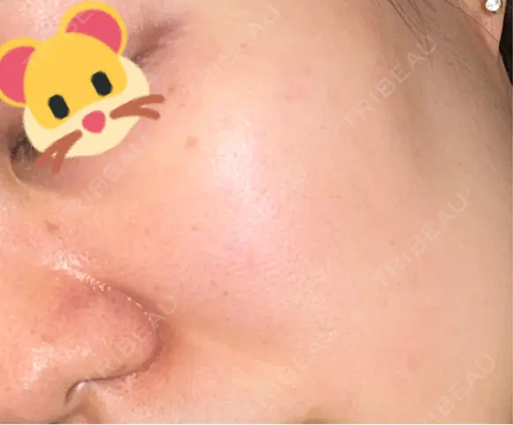 ピコスポット APスキンクリニック銀座 AFTER メイン用