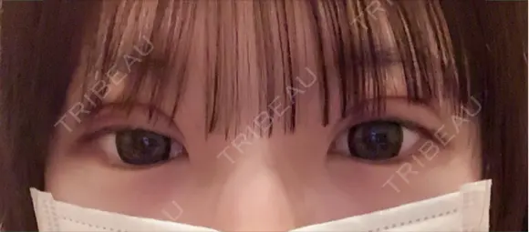 二重埋没 / 上まぶたの脂肪取り アリエル美容クリニック 郡山院 DAY 5 メイン用