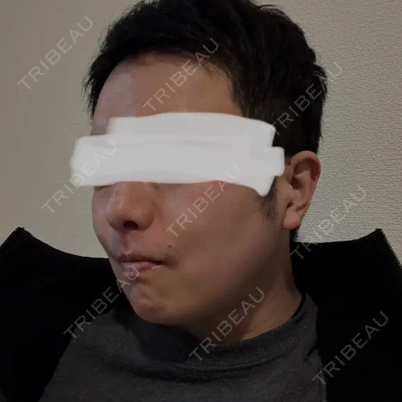 脂肪溶解注射（顔） 上野注入クリニック AFTER メイン用