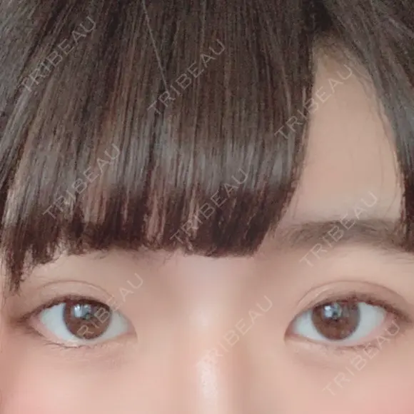 二重切開 / 眼瞼下垂（切開） 広島プルミエクリニック AFTER メイン用