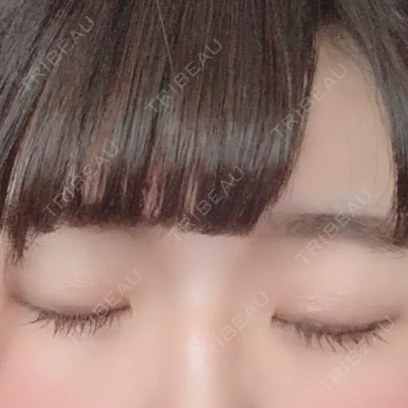 二重切開 / 眼瞼下垂（切開） 広島プルミエクリニック DAY 94 メイン用