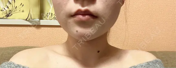 ボトックス（エラ・小顔） / ボトックス（肩） アリエル美容クリニック 水戸院 DAY 5 メイン用