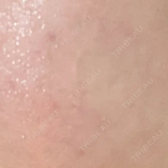 イオン導入 Kinshicho Beauty Clinic （錦糸町ビューティークリニック） AFTER メイン用