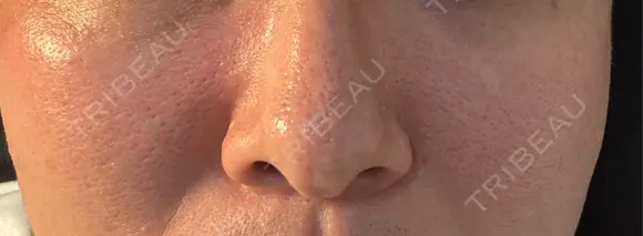 美肌レーザー / シミ取りレーザー / 美白レーザー / エレクトロポレーション / 毛穴洗浄（ハイドラフェイシャルなど） / ピコレーザートーニング（美白・肝斑） / フラクショナルレーザー（毛穴・ニキビ跡） / レーザートーニング（美白・肝斑） Fellez Clinic【フェルズクリニック】 AFTER メイン用