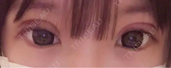二重埋没 / 上まぶたの脂肪取り アリエル美容クリニック 郡山院 DAY 6 メイン用