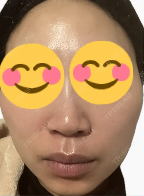 ルメッカ La Fee Clinic DAY 3 メイン用