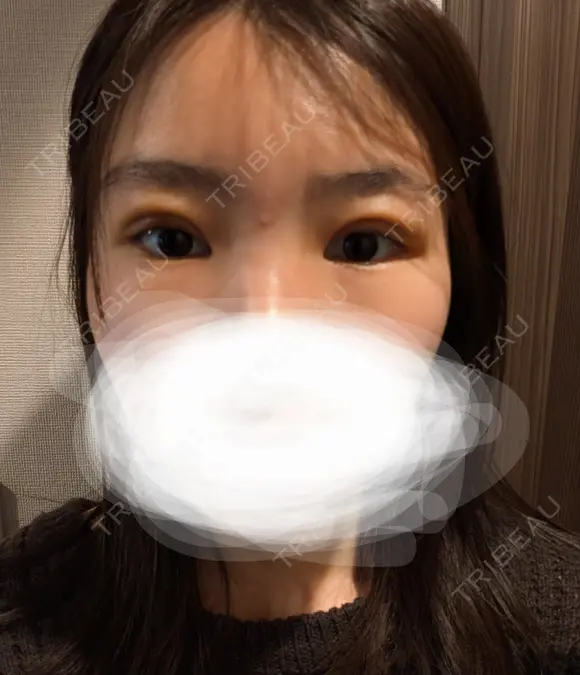 眼瞼下垂（切開） BIANCA銀座 DAY 7 メイン用