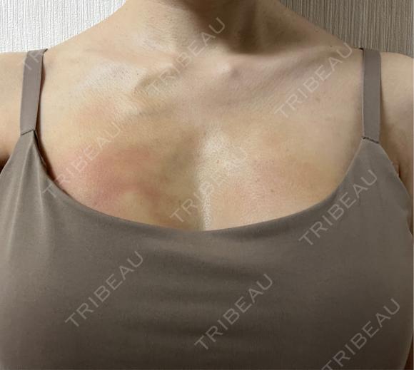 脂肪吸引（脚） / 豊胸（脂肪注入） / ボトックス（眉間） / ボトックス（額） / ボトックス（バニーライン） 藤・ナチュレ美容クリニック 銀座院 DAY 1 メイン用