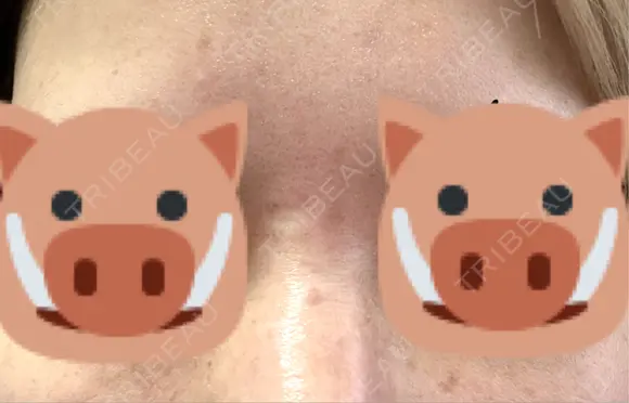 シミ取りレーザー eクリニック 金沢本院 AFTER メイン用